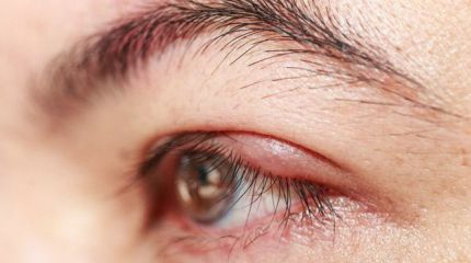 Centro de Olhos Santa Luzia - #CentroDeOlhosResponde: O hordéolo, mais  conhecido como terçol, é uma infecção dos folículos ciliares, que se  localizam na borda da pálpebra, perto dos cílios. É causado por