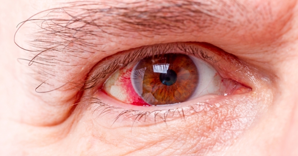Cegueira por glaucoma cresce no Brasil